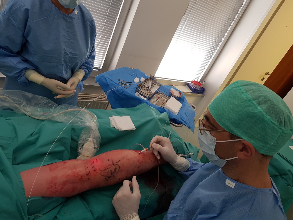 Operacijska ekipa Venula pri zdravljenju krčnih žil v letu 2018